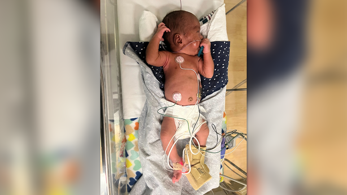 Bebé Noah Hackey con yeso en la pierna